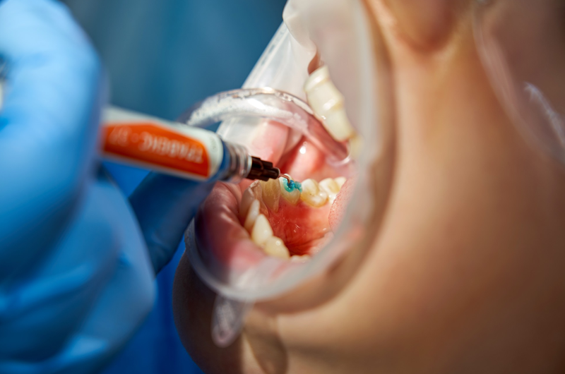 Everything You Need to Know About Dental Fillings in Walkerton: Types, Process & Aftercare