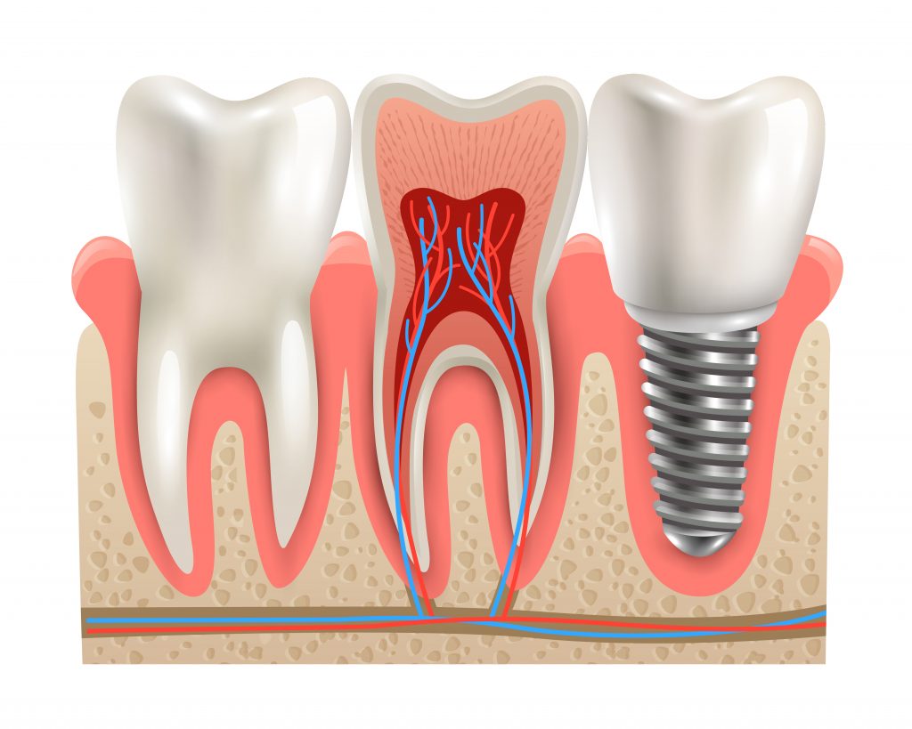 Understanding Dental Implants: Process, Benefits & Care