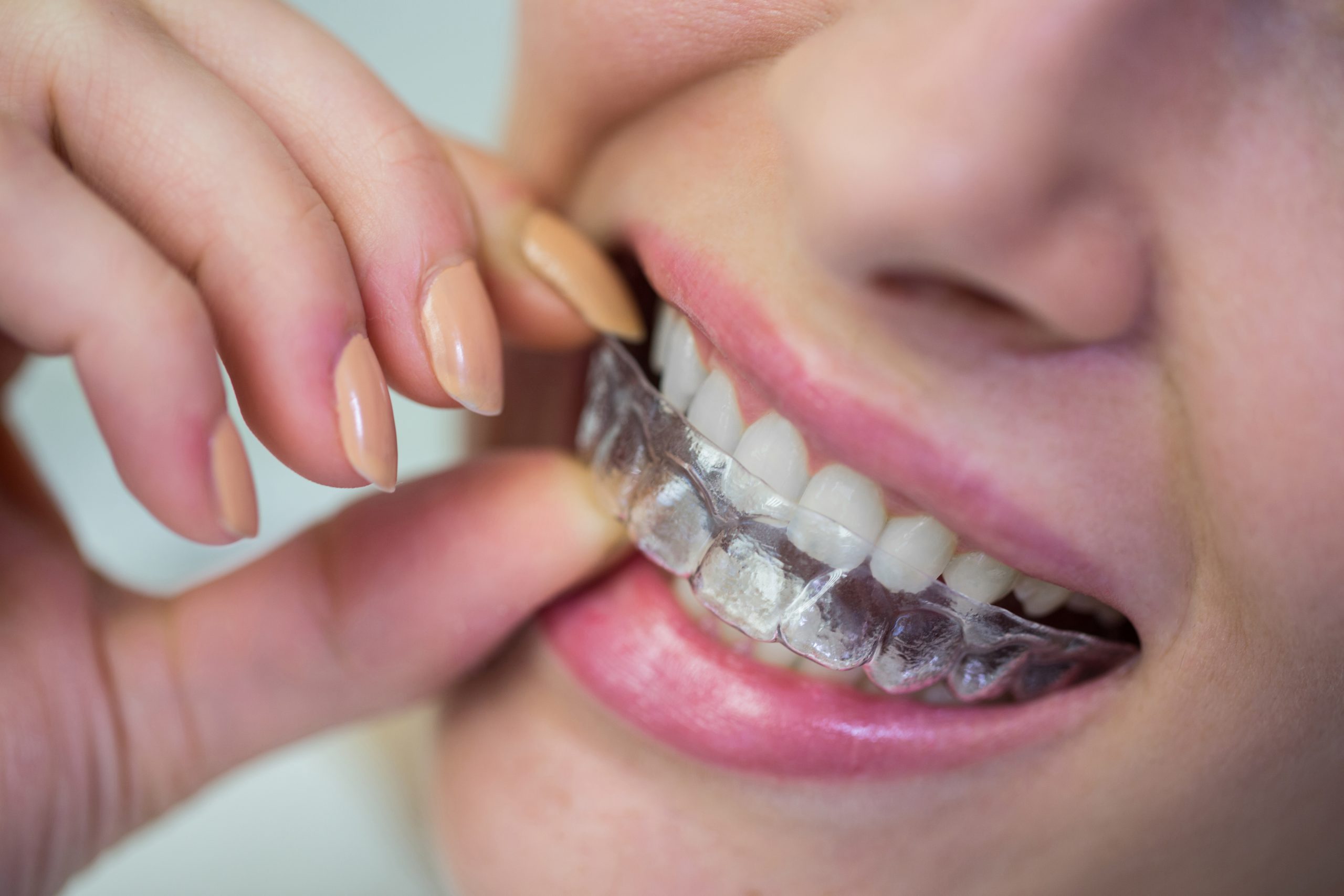 Invisalign: Everything You Need to Know About Straightening Your Smile